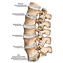 Degenerative Disc Disesese